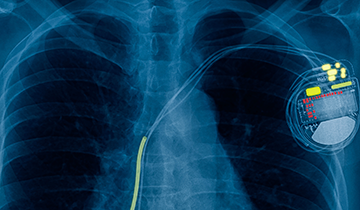 X-ray of pacemaker
